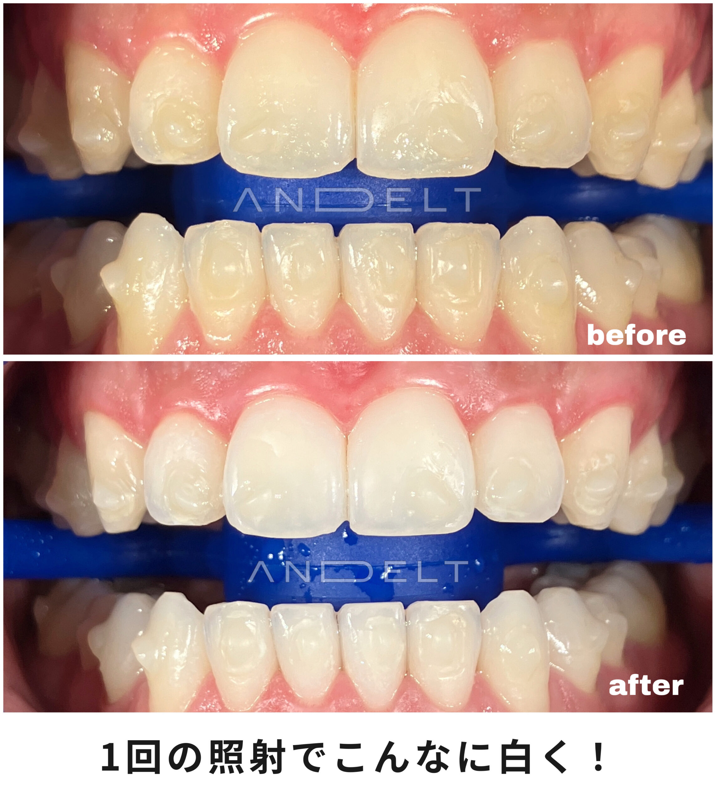 ホワイトニングのビフォーアフター（施術前と施術後の比較）